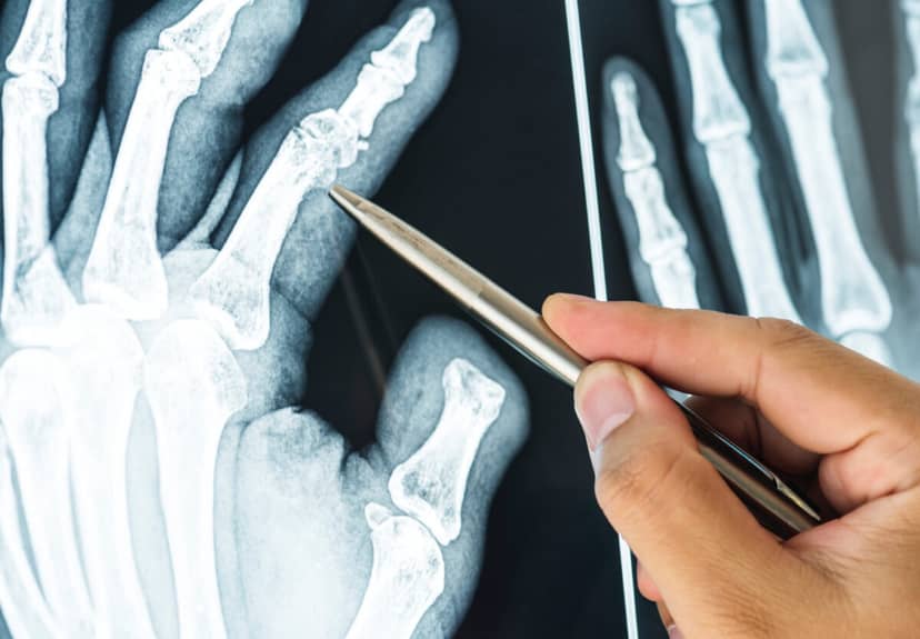 Implanty przyszłości nadchodzą. Ciekły metal, który leczy, chroni i przetrwa dekady