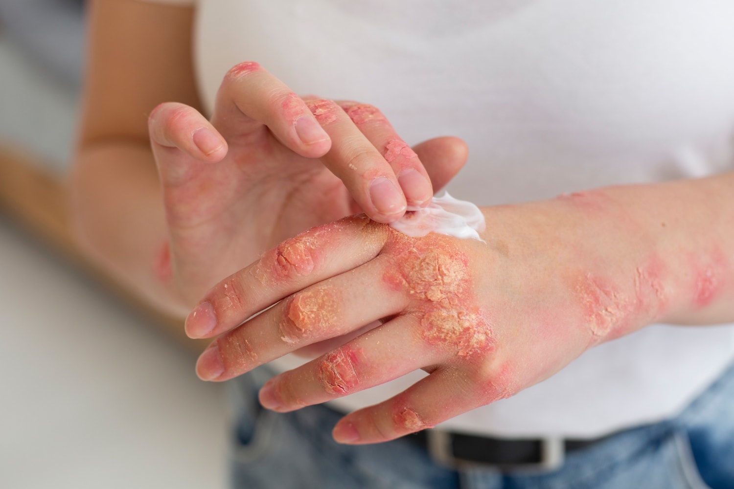 Łuszczyca to nie tylko problem dermatologiczny, a złożona choroba autoimmunologiczna /Fot. Unsplash

